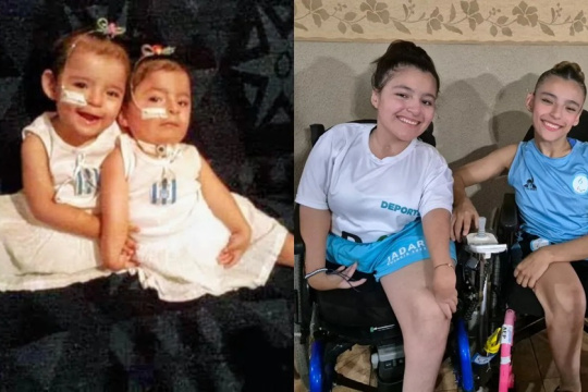 Nacieron siamesas y hoy son un ejemplo de superación en el deporte